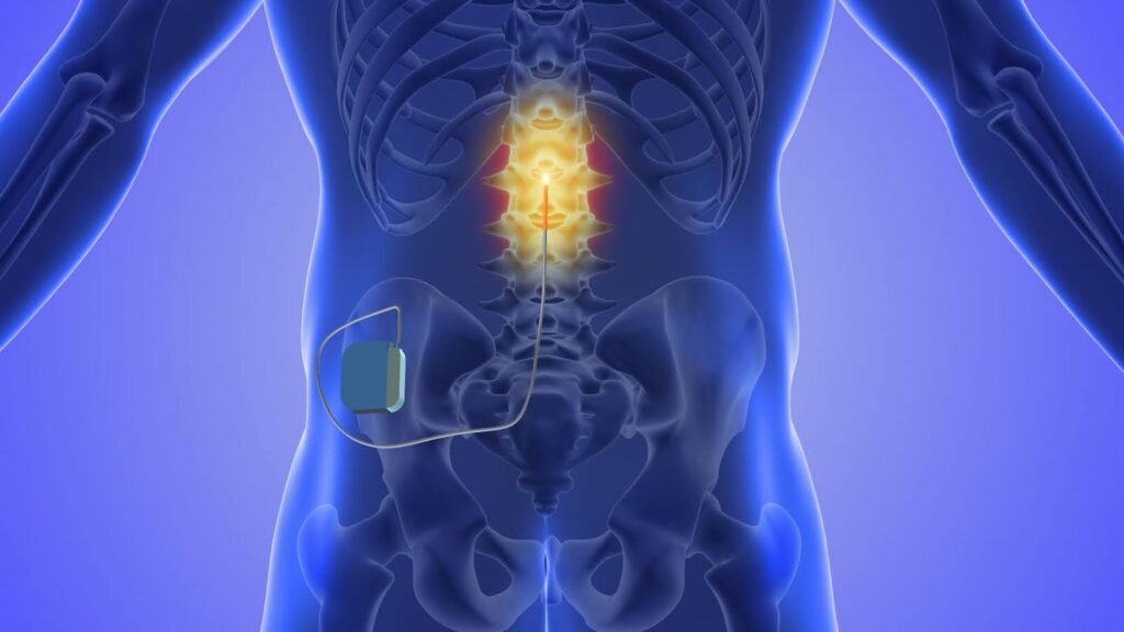 Spinal cord stimulator implant graphic.