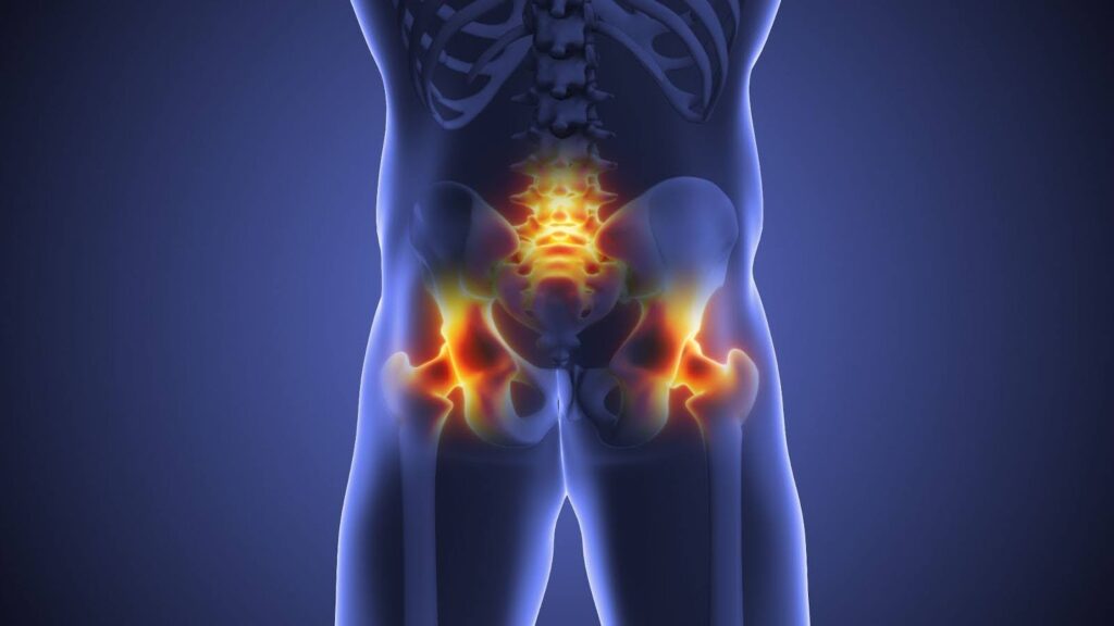 Graphic depicting sacroiliac joint (SI) pain.